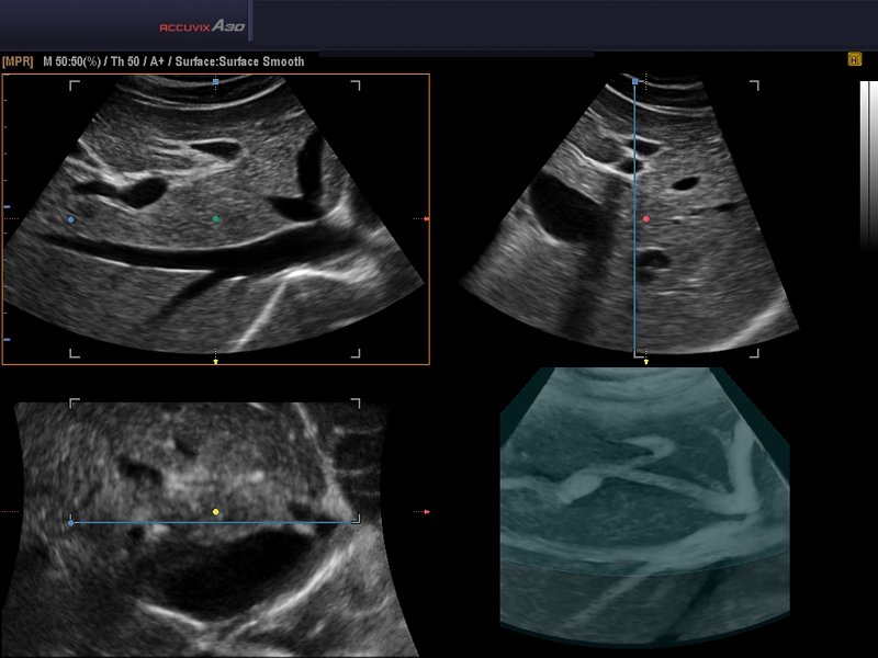 Liver, 3D inversion (echogramm №586)