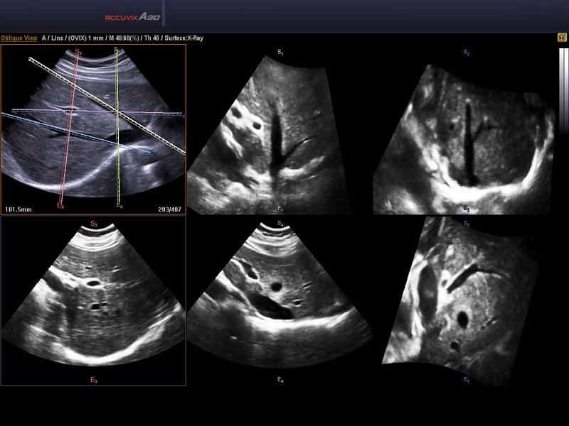 Liver, Multi OVIX, 3D (echogramm №587)