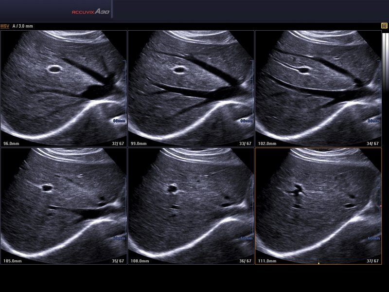 Liver, MSV & HDVI (echogramm №588)