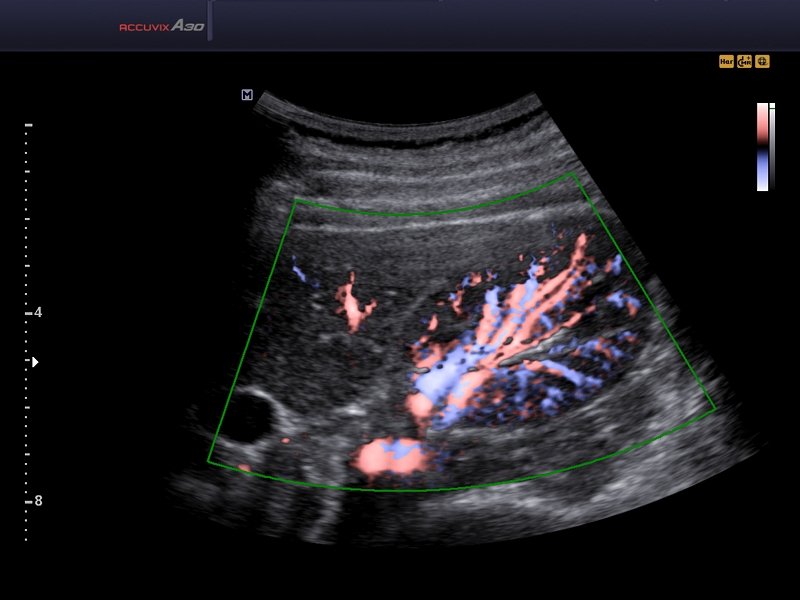 Renal vessels, DPDI (echogramm №589)