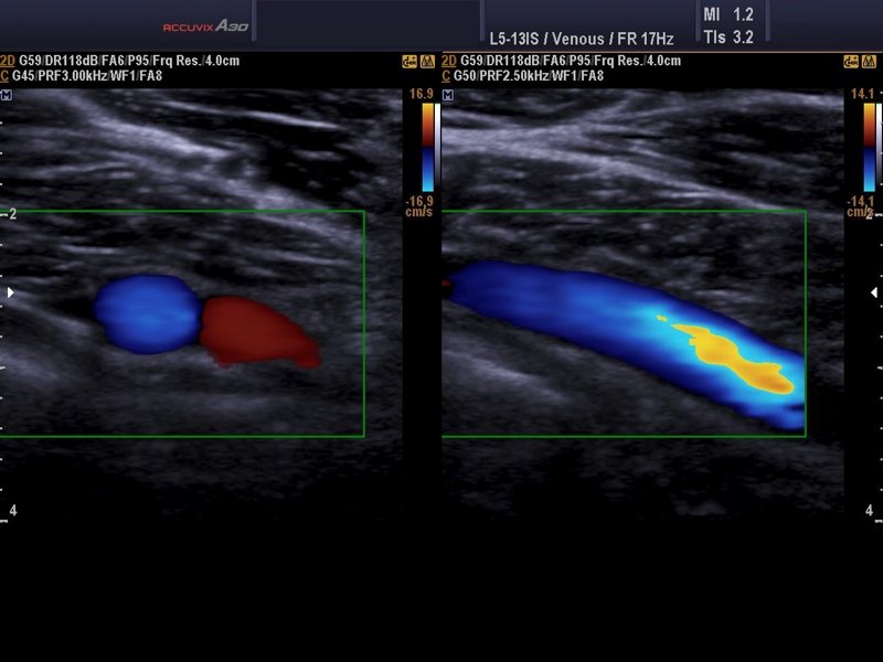 Popliteal vein, color doppler (echogramm №592)