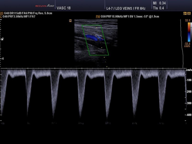 Popliteal artery, CFM & PW (echogramm №594)