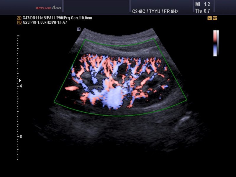 Renal vessels, S-flow (echogramm №595)