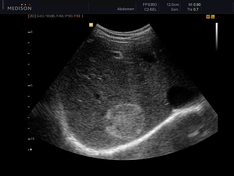 Liver - hemangioma, B-mode (echogramm №601)