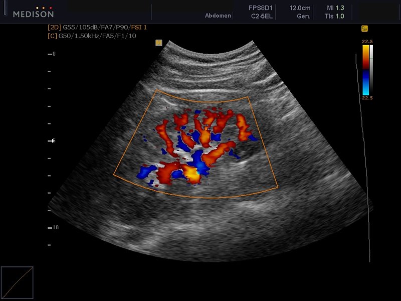 Kidney, color doppler (echogramm №603)