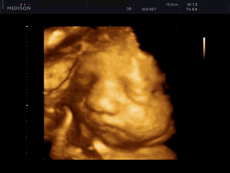 Fetal face, 3D (echogramm №607)