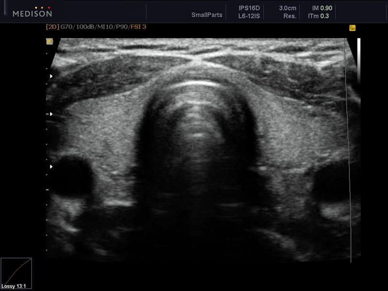 Thyroid, B-mode (echogramm №609)