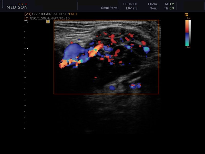 Thyroid nodule, color doppler (echogramm №610)