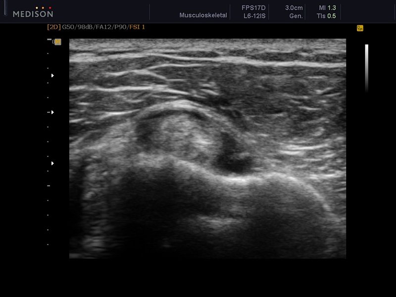 Rupture and hematoma of biceps tendon, B-mode (echogramm №611)