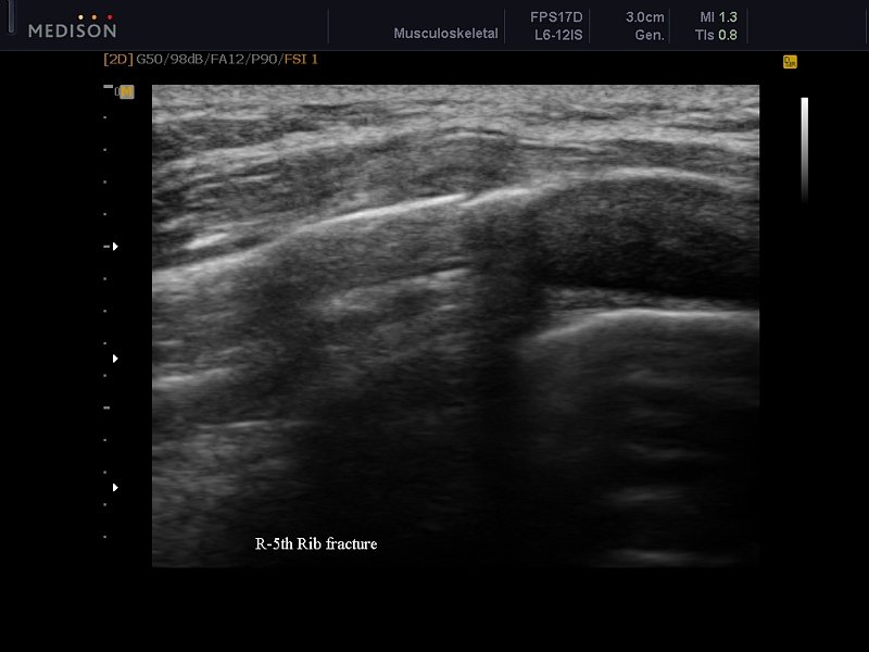 Fracture of 5-th rib, B-mode (echogramm №612)