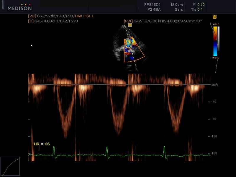 Aortic valve, CFM & PW (echogramm №614)