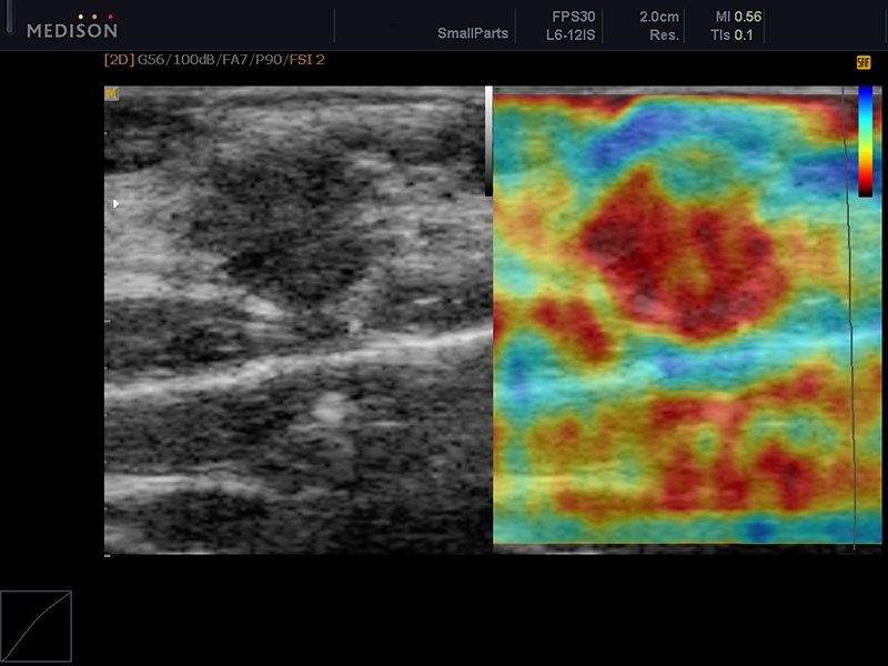 Breast - cancer, elastography (echogramm №615)