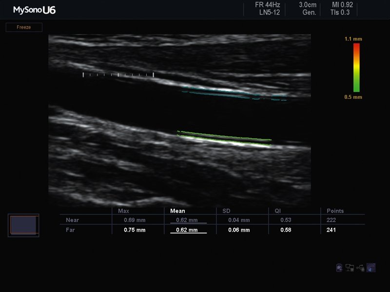 Common carotid artery, AutoIMT (echogramm №617)