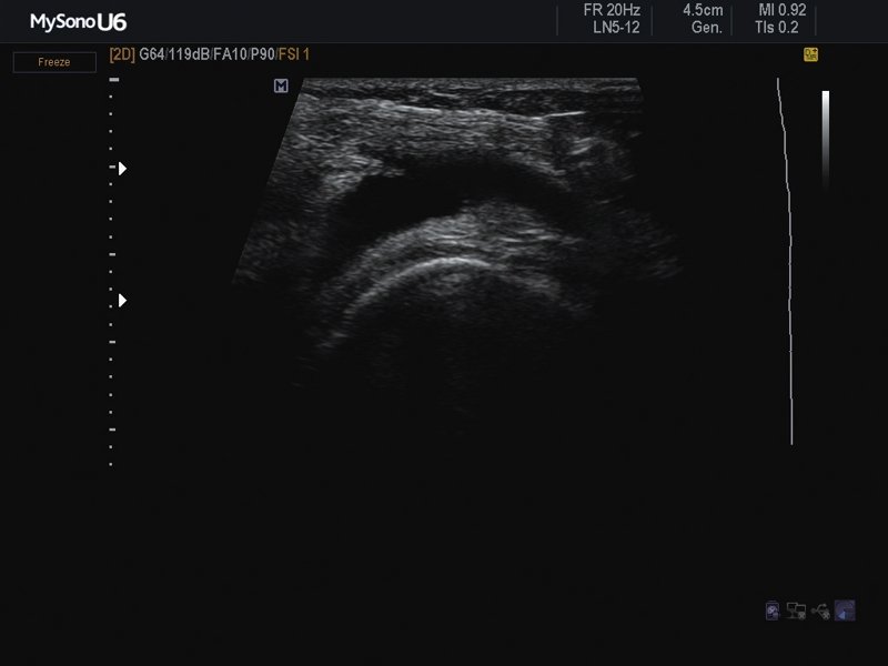 Rheumatoid arthritis, B-mode (echogramm №620)