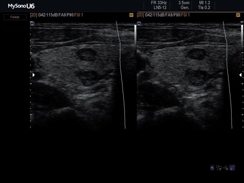 Thyroid mass, B-mode (echogramm №621)