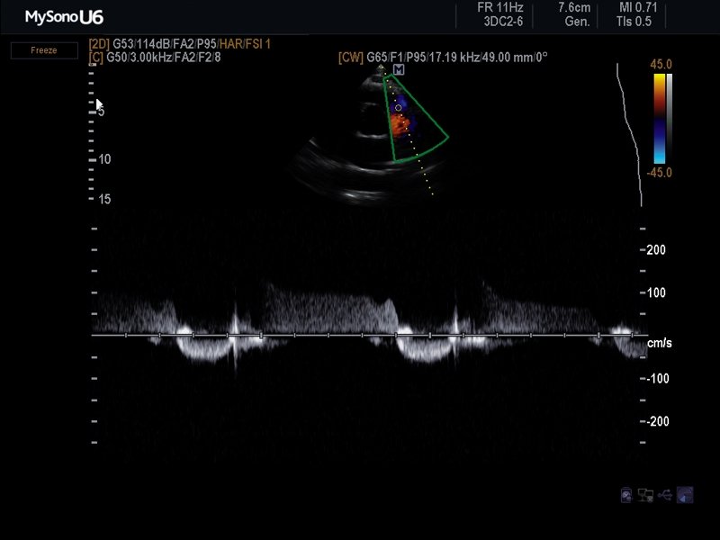 Pulmonary regurgitation, CFM & CW (echogramm №622)