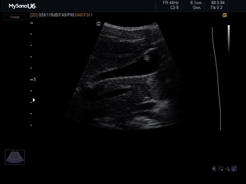 Gall bladder - polyp, В-mode (echogramm №623)