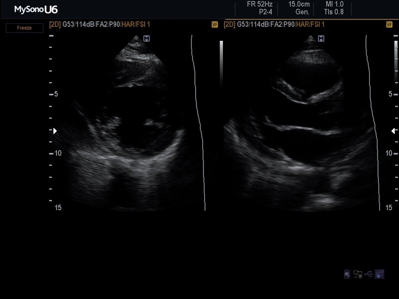 Heart (short & long axis of the LV), B-mode (echogramm №624)