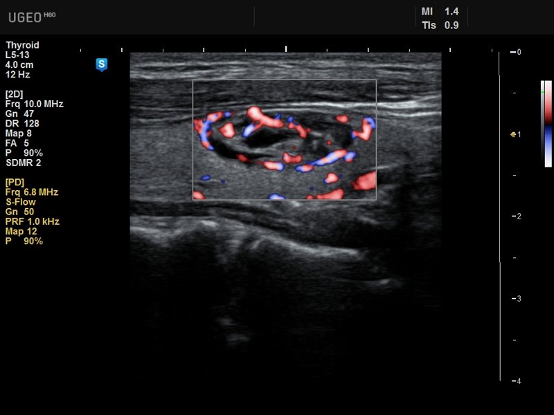 Thyroid, S-Flow (echogramm №626)