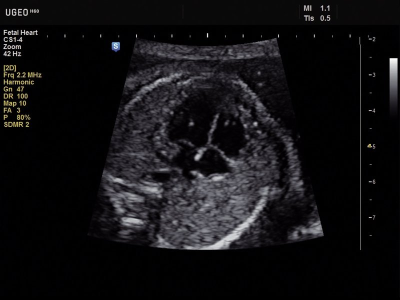 Fetal heart, B-mode (echogramm №627)