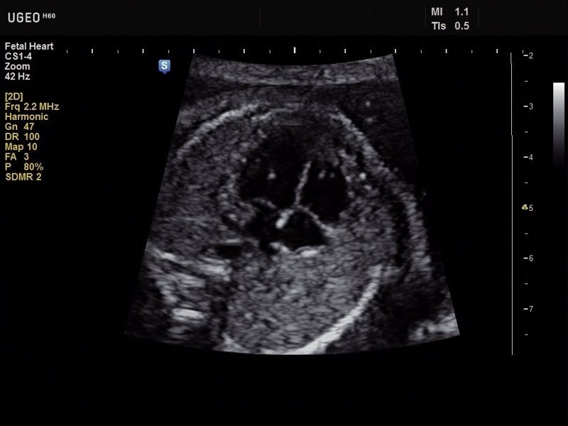 Fetal Heart Ultrasound