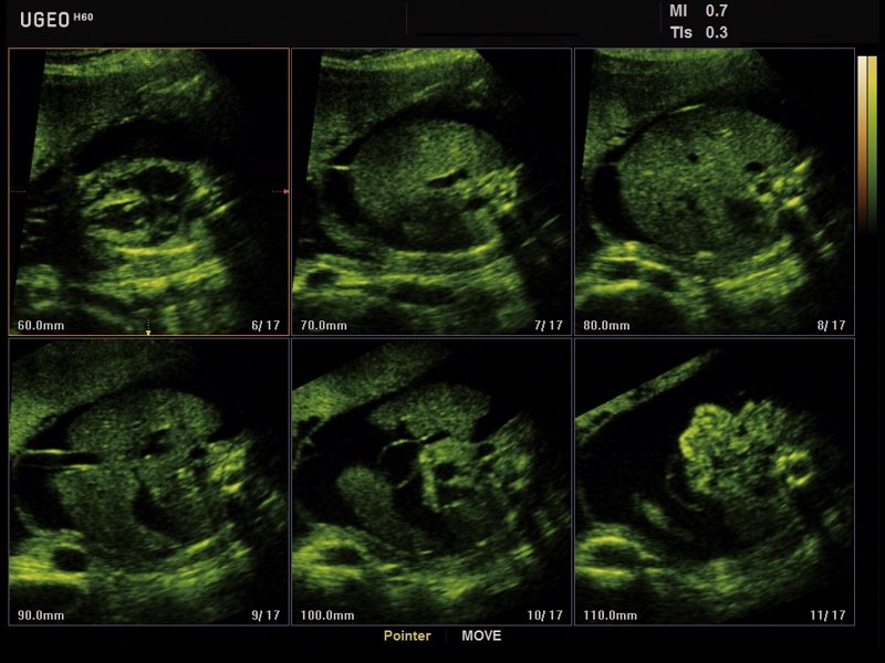 Fetal abdomen ascites, MSV (echogramm №629)