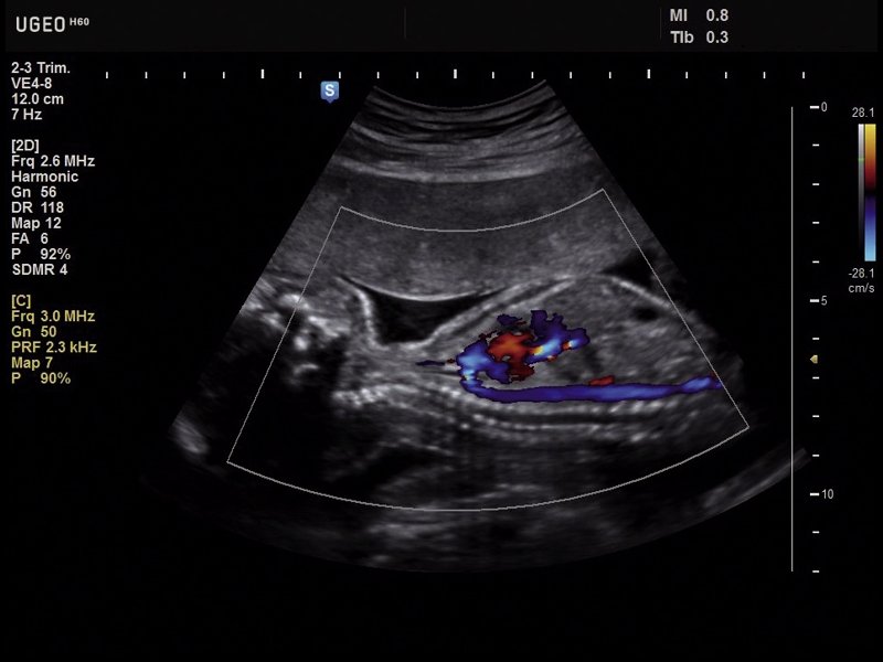 Fetus - aorta, CFM (echogramm №630)