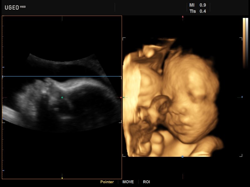Fetal face, 3D (echogramm №631)