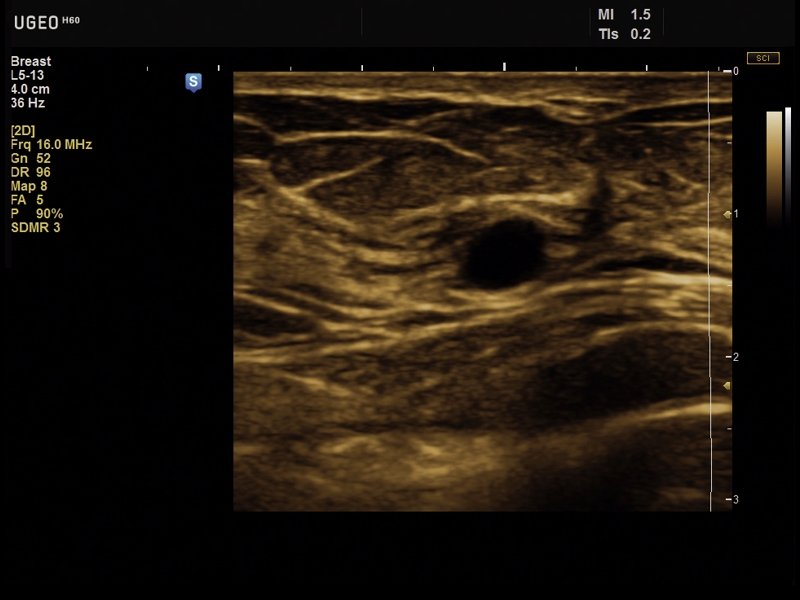 Breast - cyst, B-mode (echogramm №632)