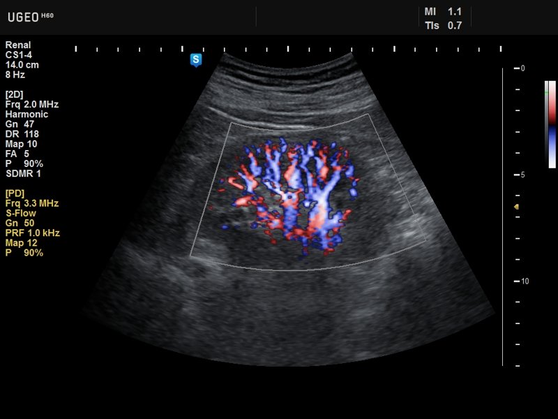 Renal vessels, S-flow (echogramm №633)