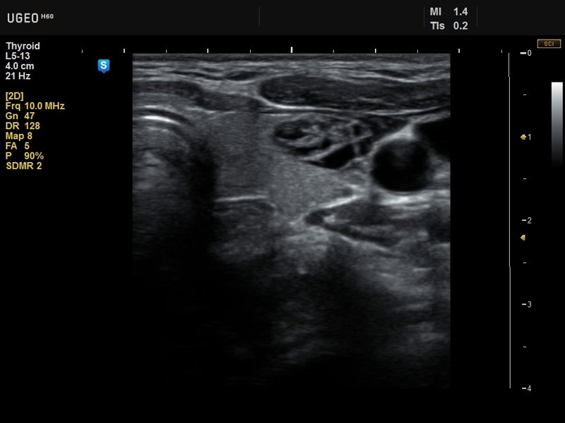 Thyroid, SDMR (echogramm №634)