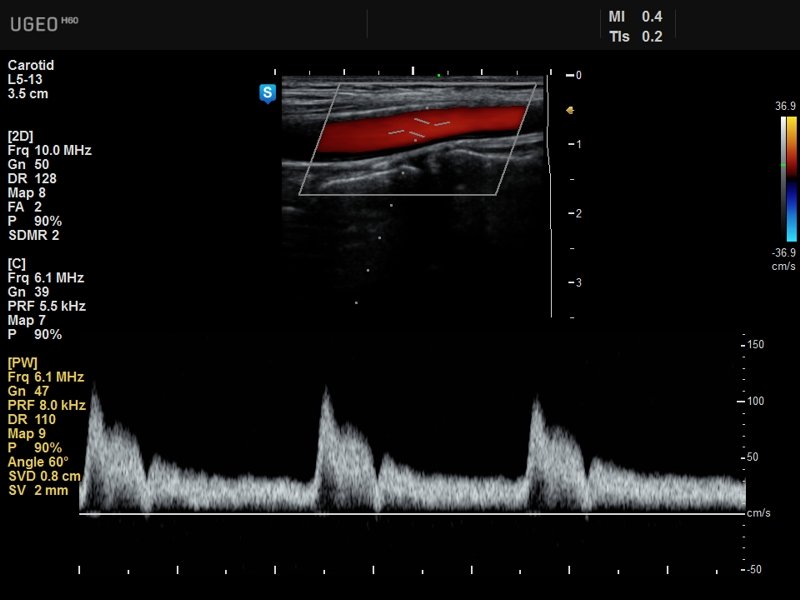 Common carotid artery, CFM & PW (echogramm №637)