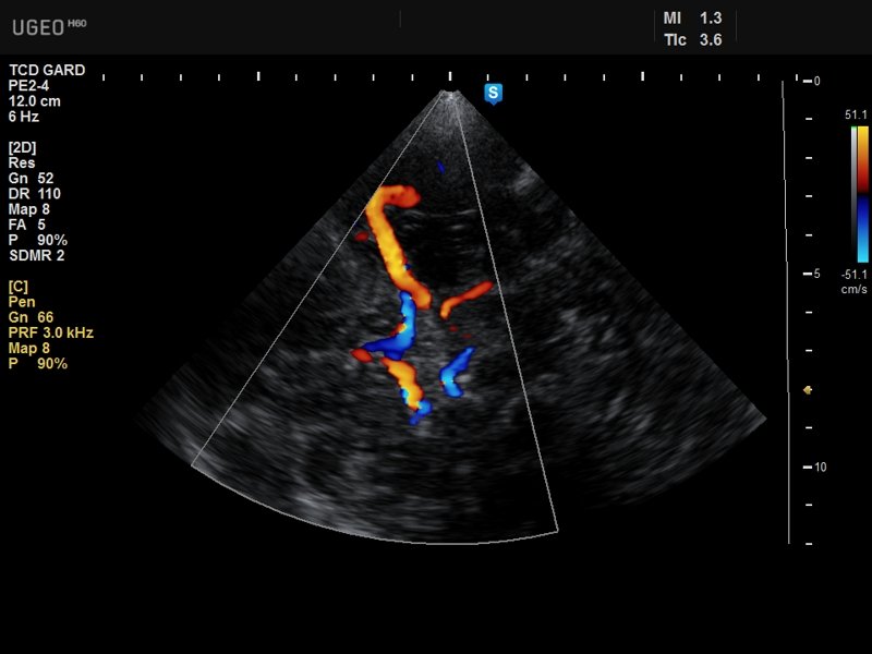 Circle of Willis, color doppler (echogramm №641)