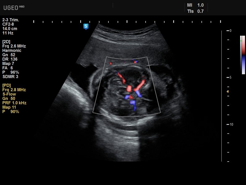 Fetus - brain vessels, color doppler (echogramm №642)