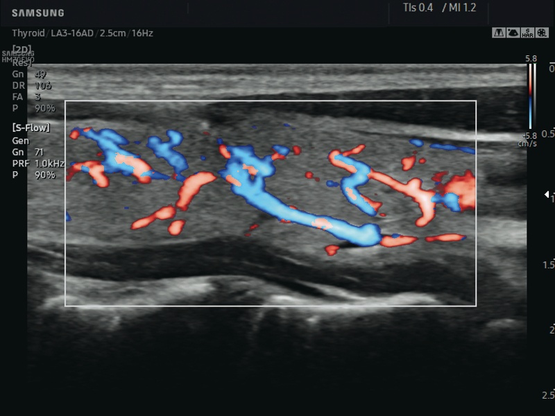 Thyroid, S-Flow (echogramm №643)