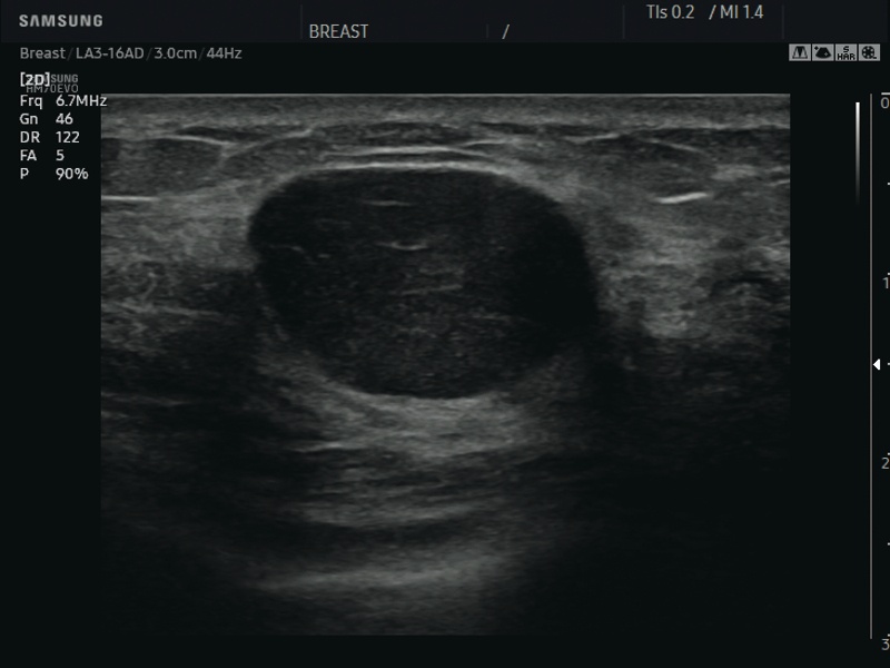 Breast - nodule, Clear Vision (echogramm №644)