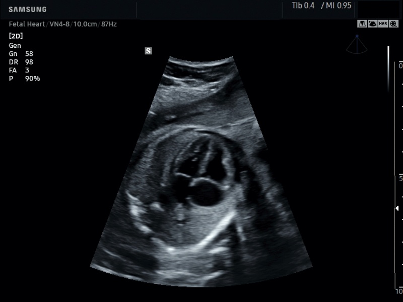  Fetal heart, ClearVision (echogramm №646)