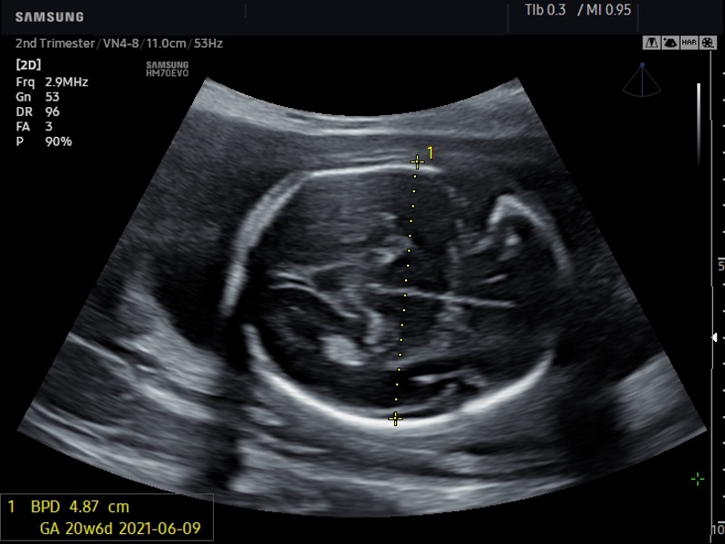 Fetus, BiometryAssist (echogramm №647)