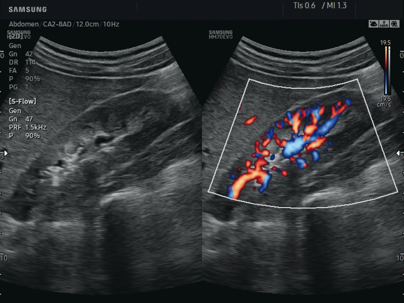 Kidney in S-Flow (echogramm №648)