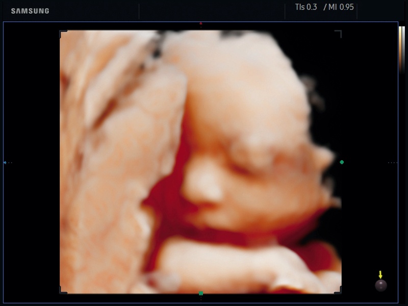 Fetal face, Realistic Vue 3D (echogramm №649)