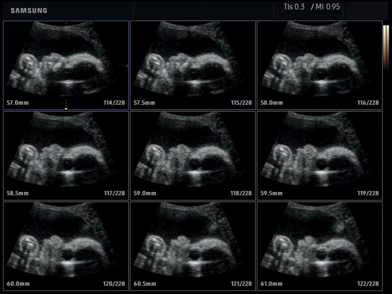 Fetal head, MSV (echogramm №650)