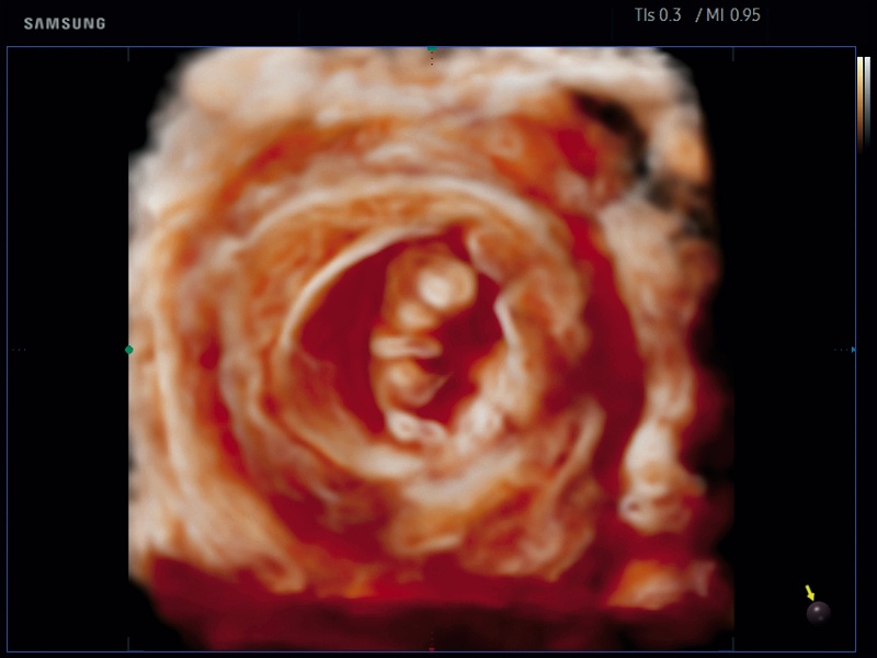 Fetus - 1-st trimester, Realistic Vue 3D (echogramm №651)