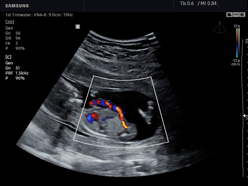 Umbilical cord, S-Flow (echogramm №652)