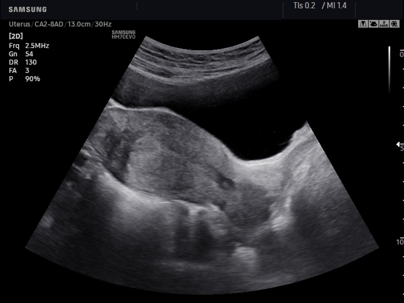 Uterus, S-Harmonic (echogramm №654)