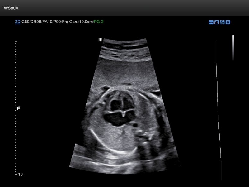 Fetal heart (4 chamber view), B-mode (echogramm №655)