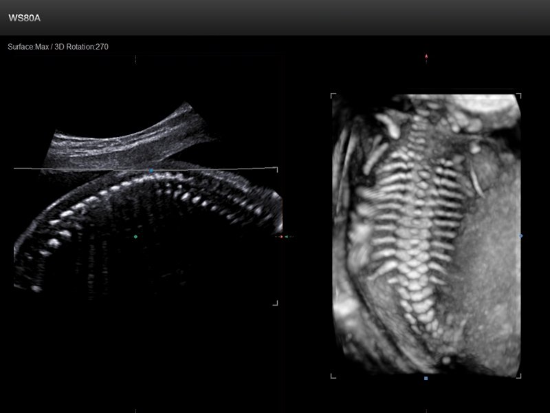 Fetal spine, ClearVision (echogramm №656)