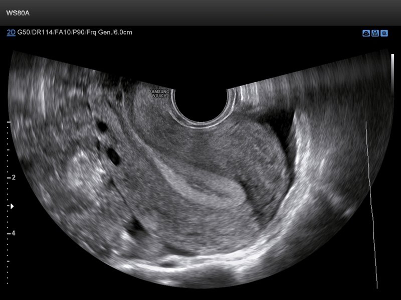 Uterus, B-mode (echogramm №657)