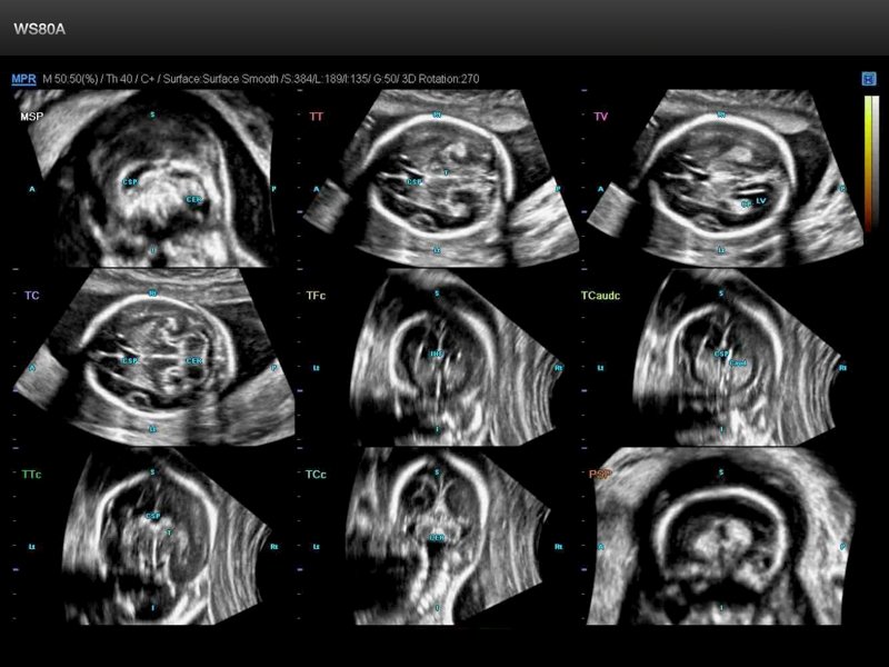 Fetal brain, 5D CNS (echogramm №659)