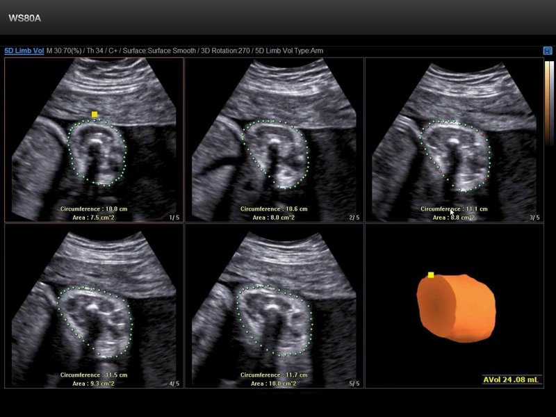 Fetus, 5D Limb Vol (echogramm №660)