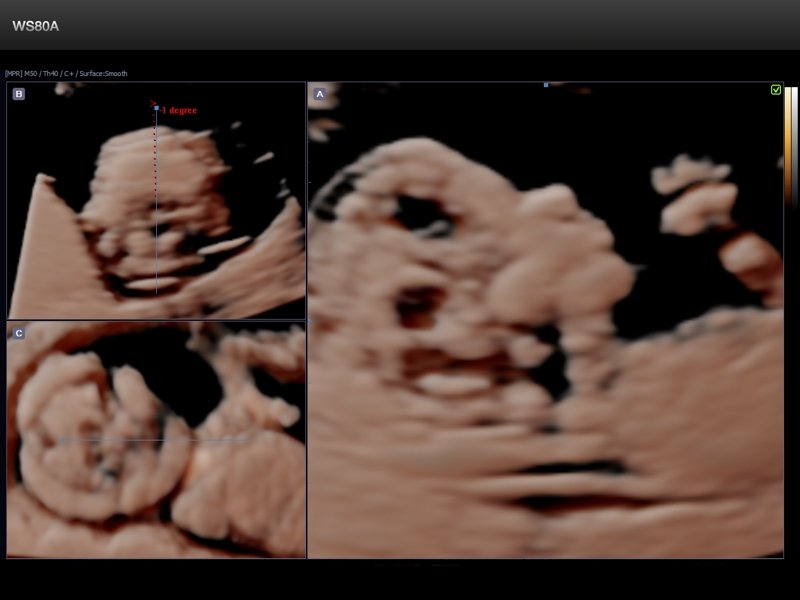 Fetus - nuchal translucency, 5D NT (echogramm №661)